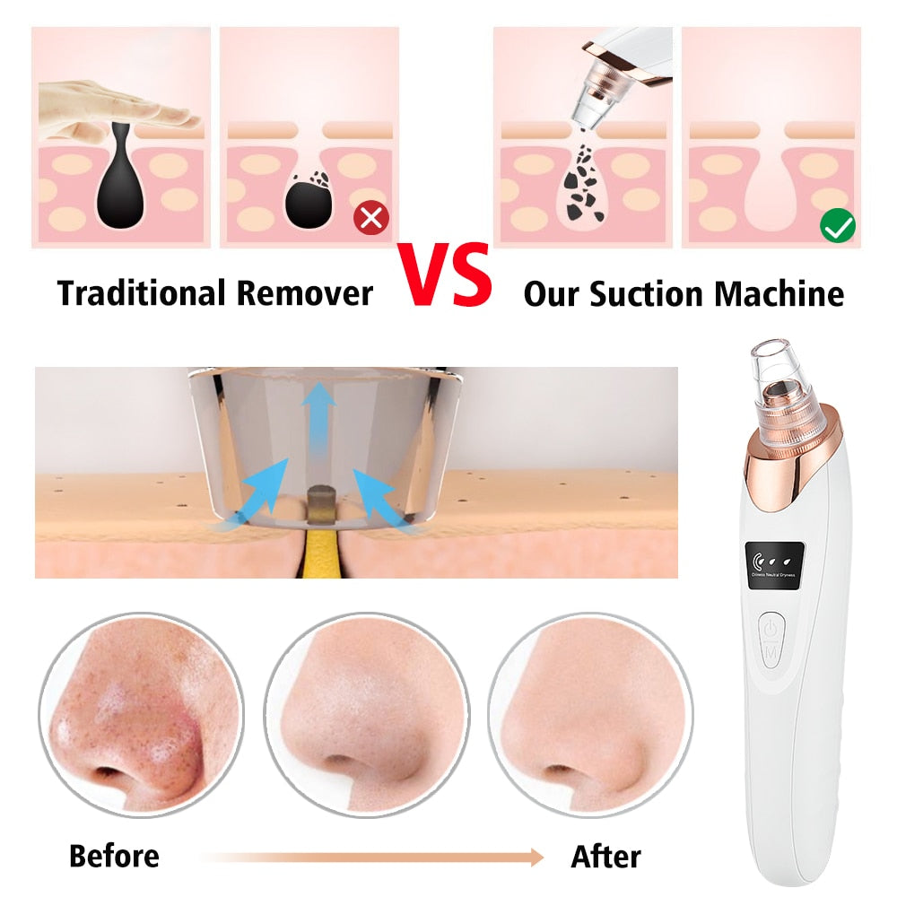 HexoClear™ Vacuum Blackhead Remover