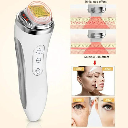 HexoLift™ – Dot Matrix Facial Lifting & Skin Rejuvenation Device