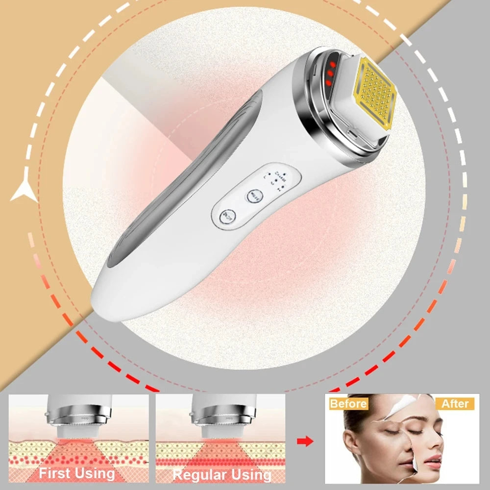 HexoLift™ – Dot Matrix Facial Lifting &amp; Skin Rejuvenation Device