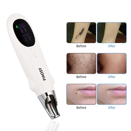 PIAOSY™ Picosecond Pen for Tattoo, Dark Spot & Acne Scar Removal
