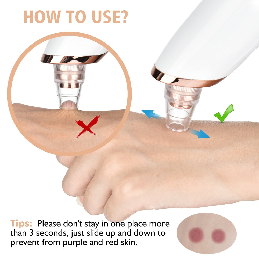 HexoClear™ Vacuum Blackhead Remover