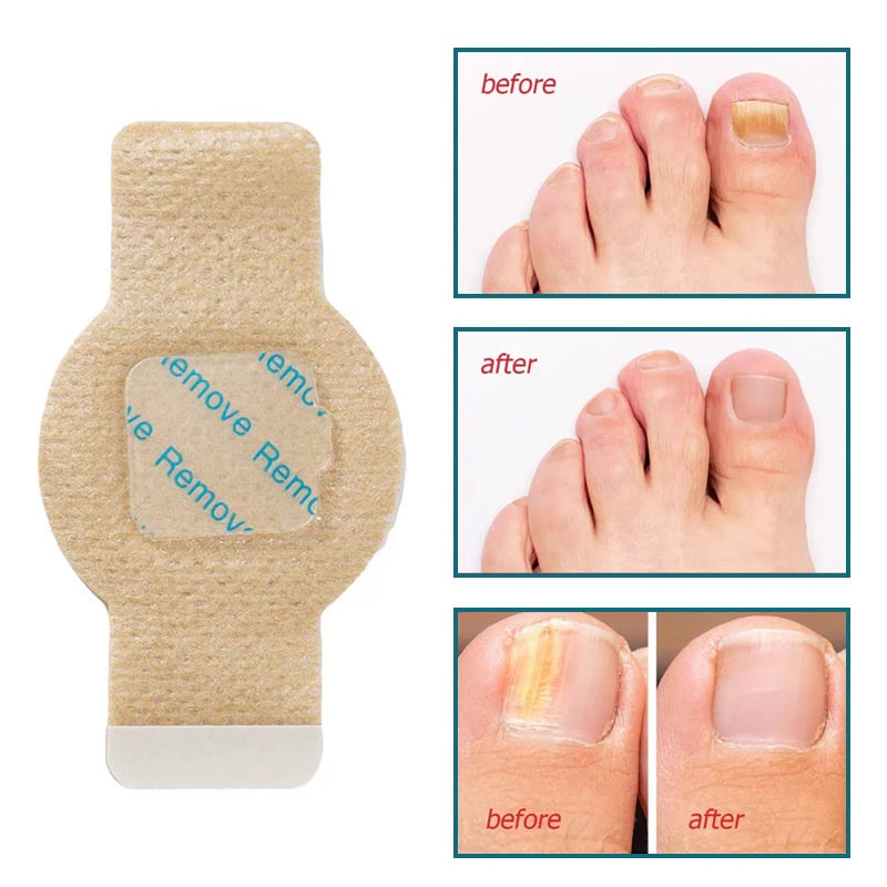 HexoNail™ Fungal Nail Repair Patches – Hydrogel Toenail & Fingernail Treatment (21-Pack)