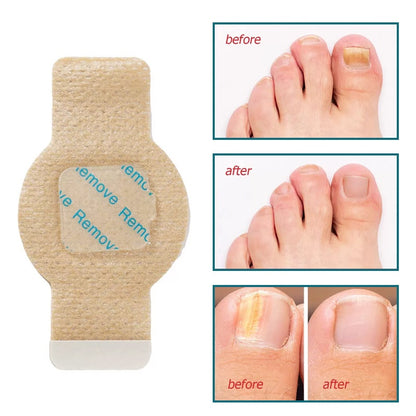 HexoNail™ Fungal Nail Repair Patches – Hydrogel Toenail & Fingernail Treatment (21-Pack)