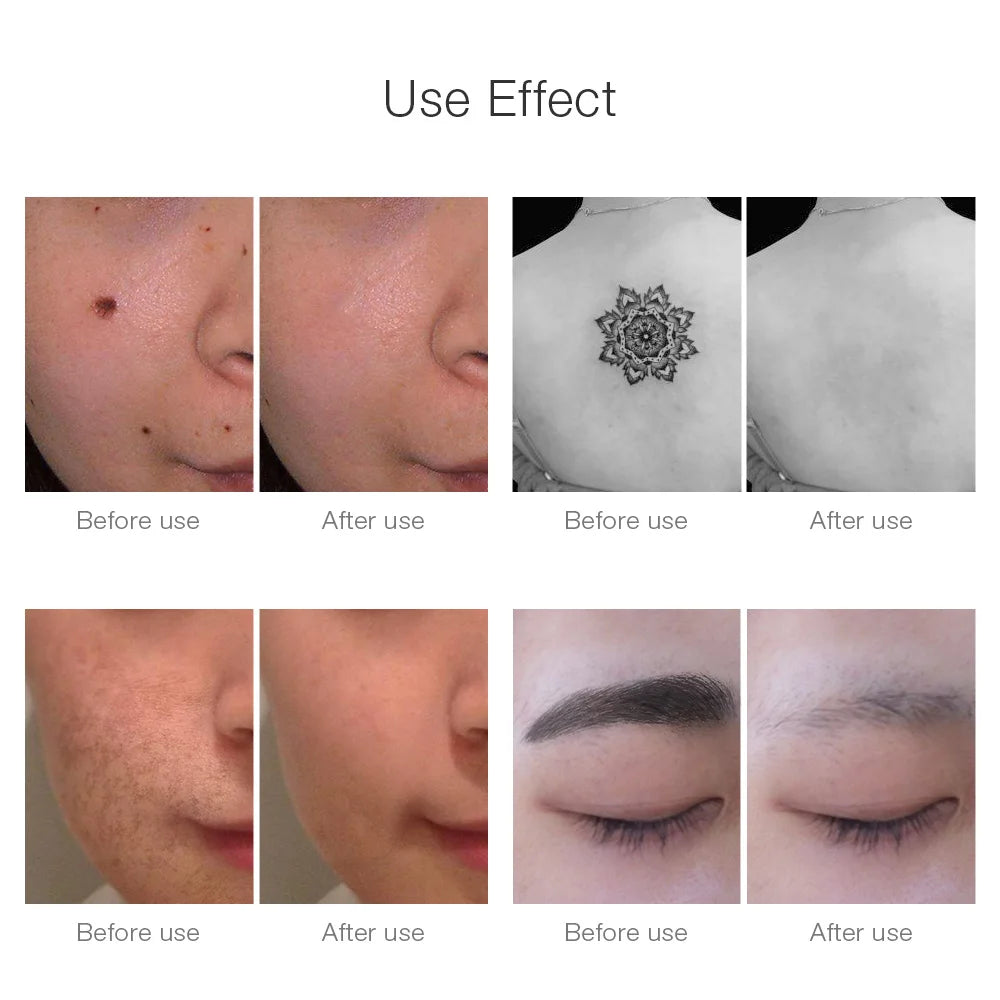 Neatcell™ – Picosecond Laser Remover For Tattoos &amp; Spots