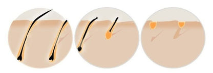 HexoSkin™ At-Home IPL Laser Hair Removal Device