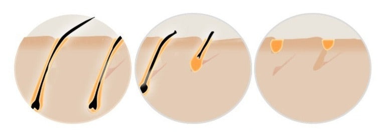 HexoSkin™ At-Home IPL Laser Hair Removal Device