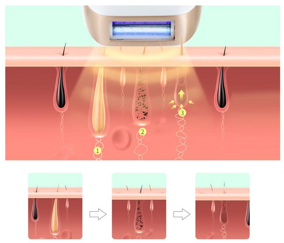 HexoSkin™ IPL Laser Hair Removal Device