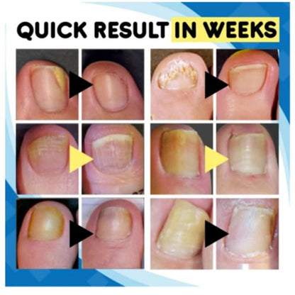 HexoNail™ Fungus Treatment Kit