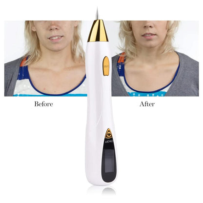 HexoPlasma™️ Mole Removal Pen