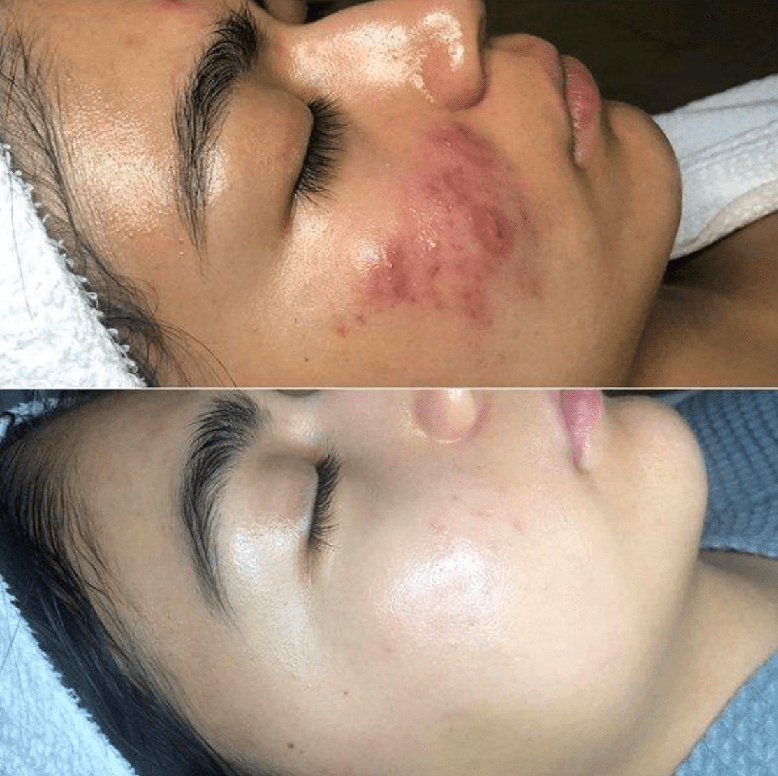 HexoWand™ High Frequency Skin Therapy